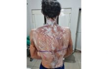 Estudantes da UFPR de Palotina sofrem queimaduras durante aplicação de trote