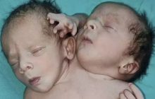 Mulher dá à luz bebê com duas cabeças, dois corações e três braços