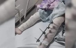 Equipe médica opera perna errada de criança de seis anos
